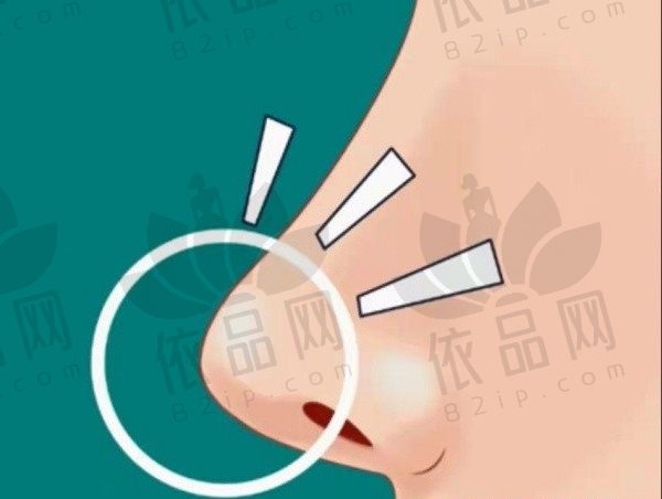 彭栋梁海峡广州做鼻子怎么样？技术成熟擅长做自然妈生鼻价格1w起