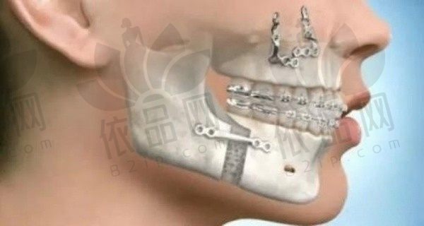 重庆松山医院肖林正颌手术费用56200元起，肖林医生正颌技术靠谱
