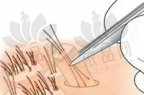 脱发打cgf多少钱一针？能保持多久？为什么医生不建议打cgf？