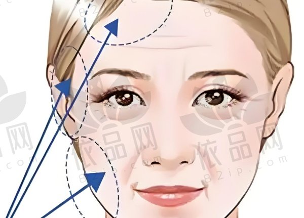 成都素美刘远程做筋膜提升怎么样