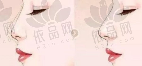 杭州张龙医生做鼻子怎么样