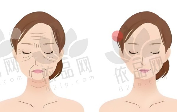 超声V拉美能维持多久