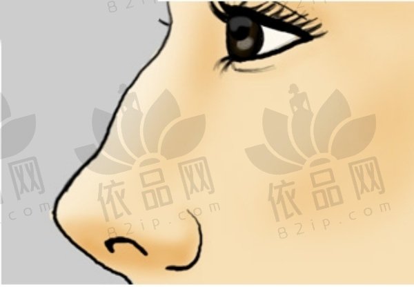 彭栋梁医生的鼻整形实例分享