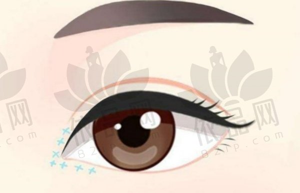 合肥华美杨鹏做眼综合技术如何