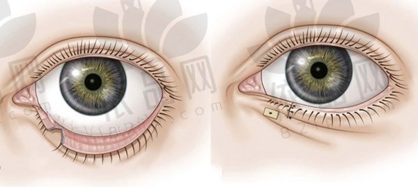 贺洁眼袋外翻修复手术做得好吗