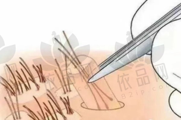 CGF脱发治疗每针多少钱