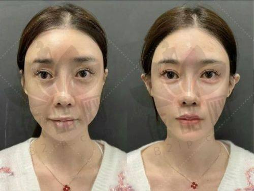 不同医院的2025温州光子嫩肤价格