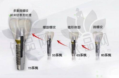 东莞固德口腔隐形牙套美学正畸优势