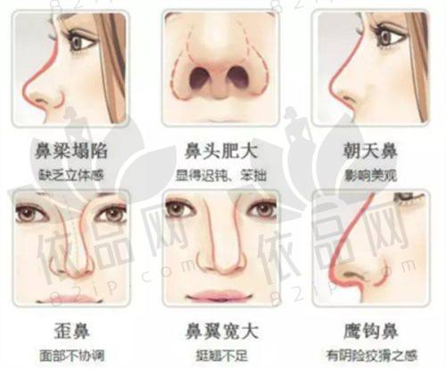 广州艺星吸脂技术特点