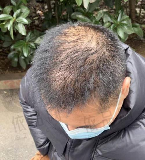 1500毛囊单位植发价格