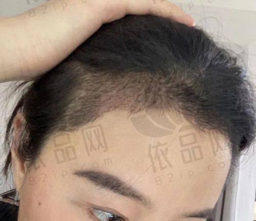 3000毛囊单位植发价格