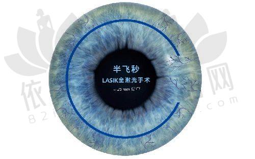 银川进川眼科医院半飞秒手术12300元起，矫正近视散光，恢复期短效果好