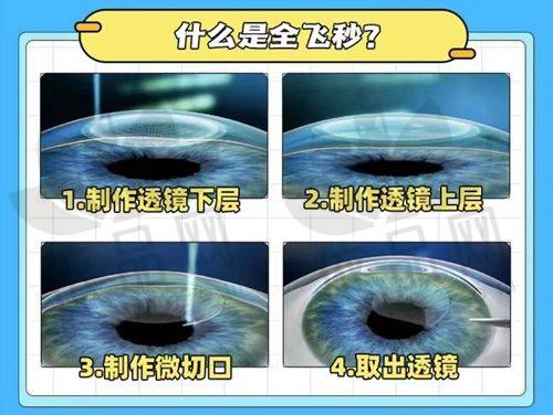 北京茗视光眼科医院全飞秒手术的优势