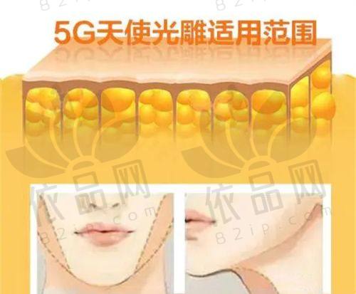 任学会医生腰腹吸脂的手术实例成效