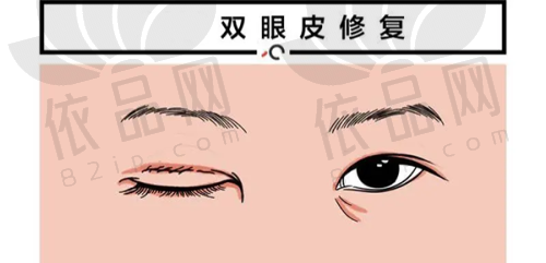 付国友院长拉皮手术价格