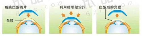 一、北京希玛林顺潮眼科医院是私立的吗？是私立医院，从资质和品牌看是正规眼科医院