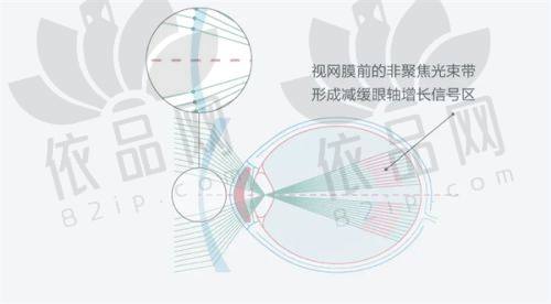 阿玛仕准分子激光近视手术价格