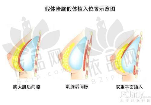 贺天遥医生脂肪隆胸技术优势