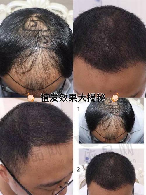 包头吴姝华美医疗美容医院植发科预约方式