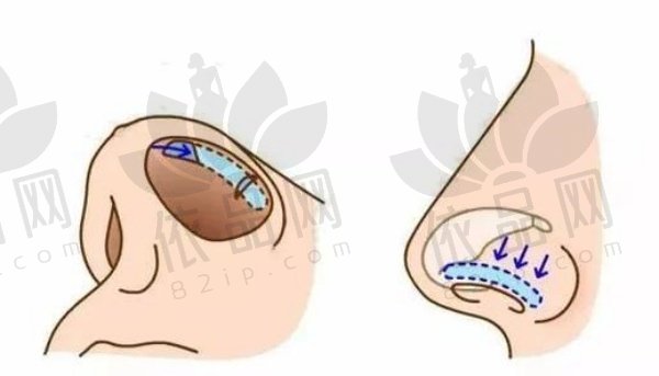 成都艺星周顺波做鼻子价格表揭秘：精细化美鼻22000起、鼻修复30000起