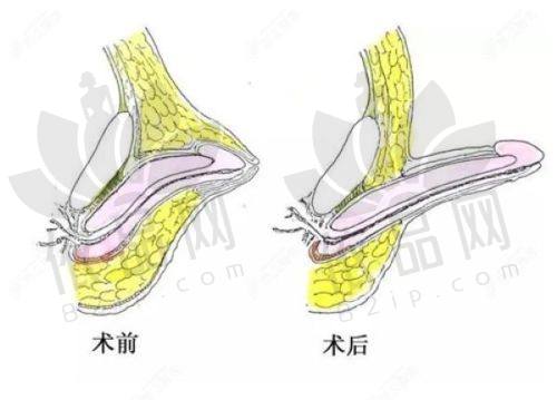 不同隆鼻材料的手术过程是怎样的？