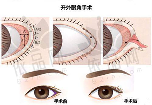 30岁以上割双眼皮又有什么特点？
