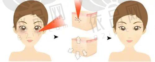 双眼皮埋线取出后的修复与注意事项