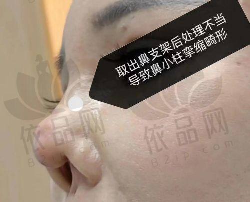 成都周顺波隆鼻审美风格