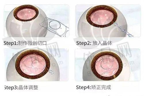 10. 全飞秒SMILE：23800元起，高端配置选择