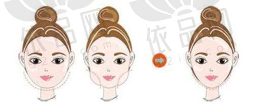 3、吴文欢（南京华美微整中 心院长）从业年限：10年+个人成就：伊妍仕指定临床注射医师、艾维岚认证操作医生、濡白天使官网认证操作医师、宝尼达官网认证注射培训导师医生简介：吴文欢拥有多年微整注射临床经验，擅长轮廓固定提升和幼态脸打造。他善于进行个性化美学设计，合理运用不同注射材料，综合改善额头、太阳穴等多个部位的皱纹、凹陷和下垂问题，注射后能让人有“返老还童”之感。