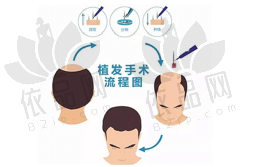 一、南京新生医院植发怎么样