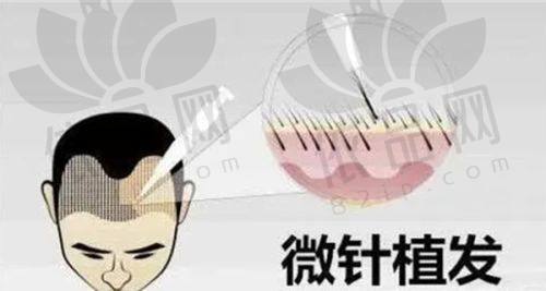 2025济南正规植发医院大盘点