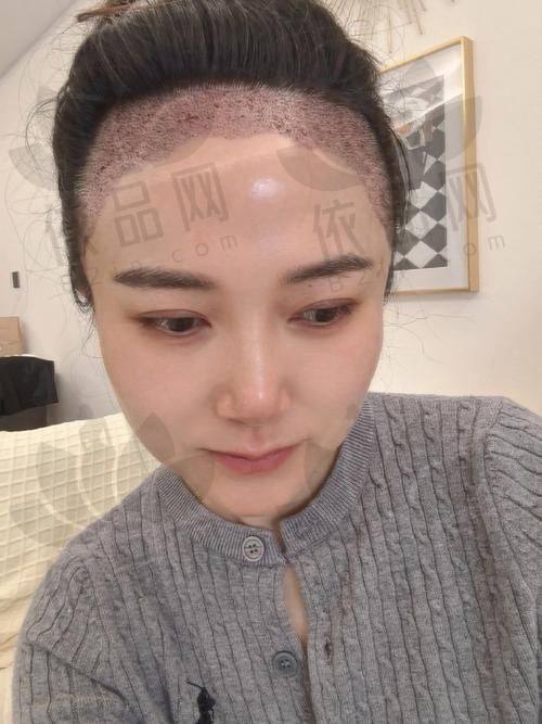 济南海峡植发：医生推荐朱声扬，他能够提供美学设计和私人定制的种植毛发方案，长期专注于解决各种毛发移植问题。医院有着25年的临床沉淀，还签约保“毛囊存活率≥95%”，感染率