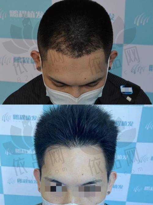 三、南京新生植发医院价格表
