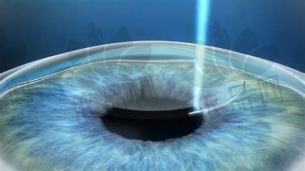2025南宁爱尔眼科近视手术价格表：全飞秒13000起、ICL28000起、半飞秒9800起