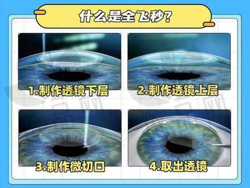 三、选择南宁爱尔眼科医院做近视矫正手术的理由