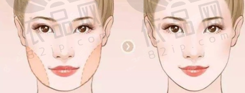 五、面部拉皮提升的适应人群和注意事项