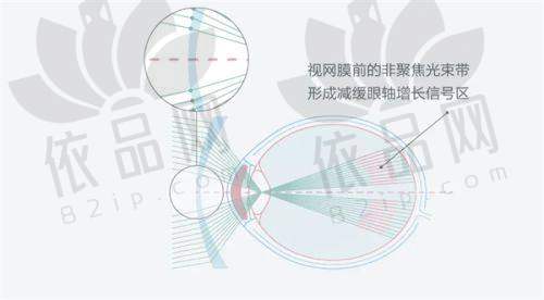 ICL晶体植入手术介绍