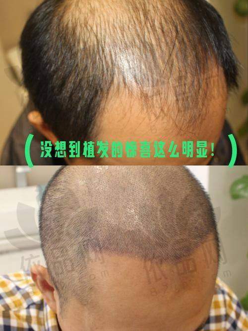 沈阳华美医院植发科正规吗