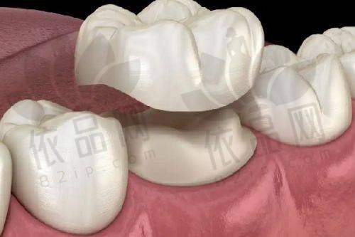 滨州牙博士口腔爱尔创全瓷牙1600元起/颗，美观耐用，为您重塑健康好牙！