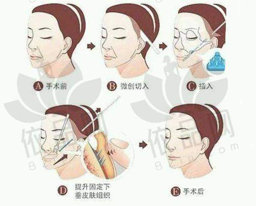 三、北京八大处隆胸手术价格