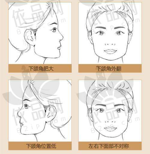 如何选择适合自己的玻尿酸及注射方案