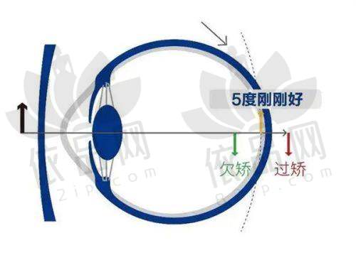 半飞秒激光类手术价格