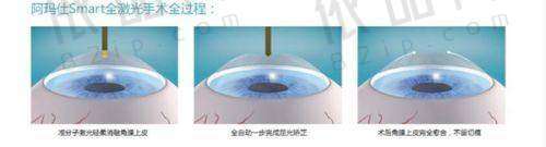 白内障手术价格
