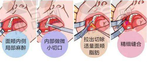成都东篱医院整形美容科割双眼皮技术优势