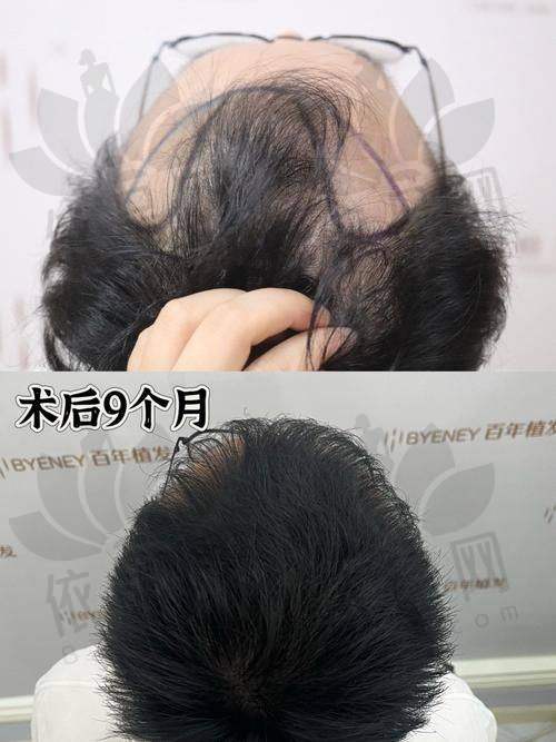 沈阳牛大夫植发钟银祥医生擅长项目