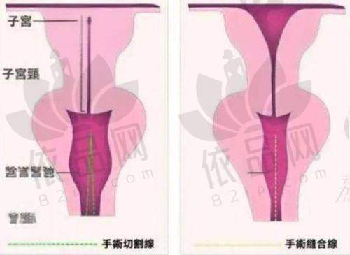 北京联合丽格腰腹吸脂实例成效