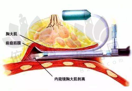 国内奥美定取出医院排名之西安国际医学整形医院