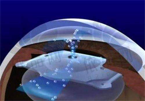 2025湛江近视手术配套检查费用