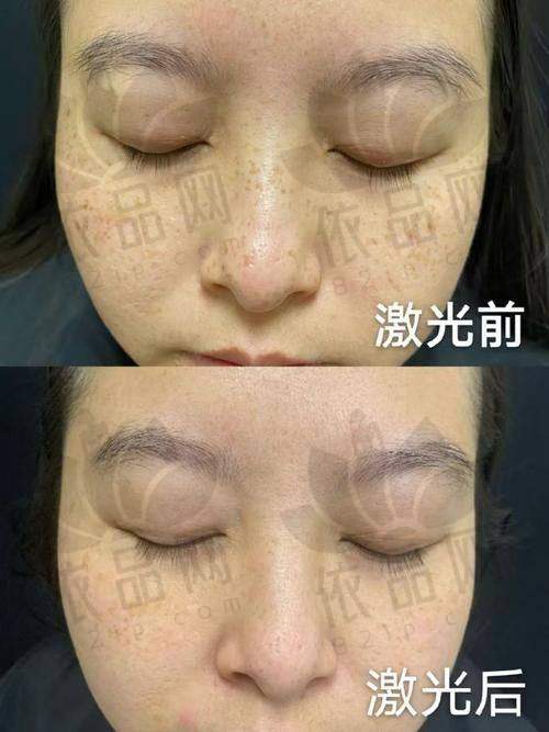 重庆艺星激光祛斑项目价格